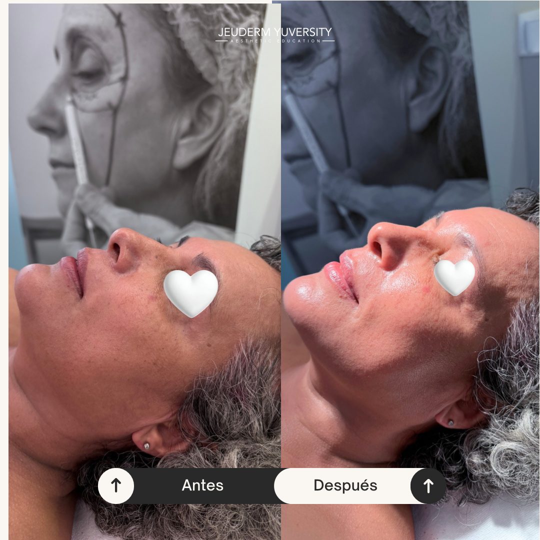 Antes y después — tratamiento de dermoestética coreana