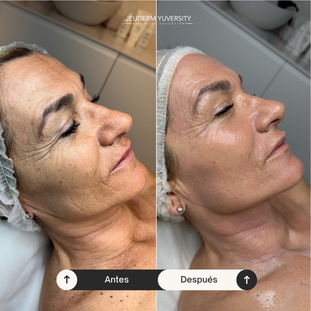 Antes y después — protocolo facial JD Yuversity